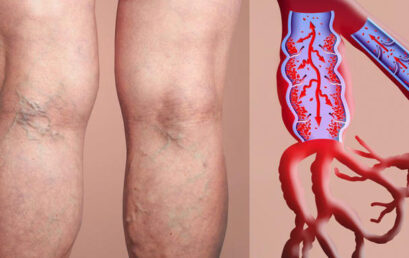 Esta es la mejor vitamina para mejorar la circulación sanguínea y eliminar las varices