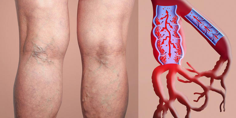 Esta es la mejor vitamina para mejorar la circulación sanguínea y eliminar las varices Esta es la mejor vitamina para mejorar la circulación sanguínea y eliminar las varices