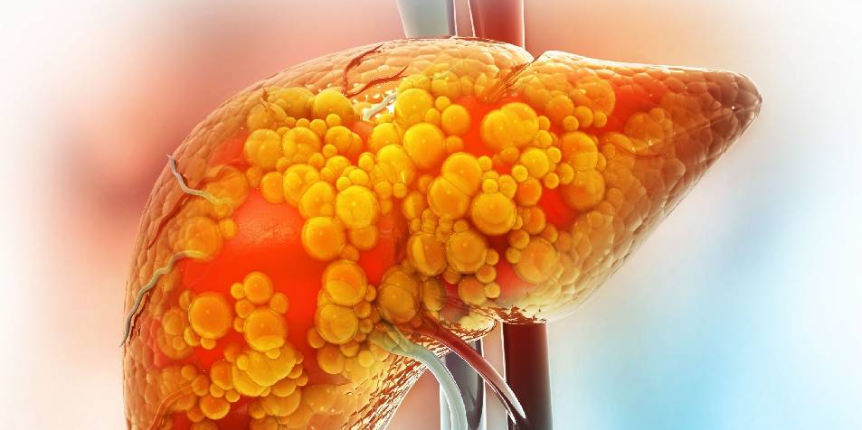 ¿Qué comer si tiene hígado graso? Alimentos recomendados y los que debería evitar ¿Qué comer si tiene hígado graso? Alimentos recomendados y los que debería evitar